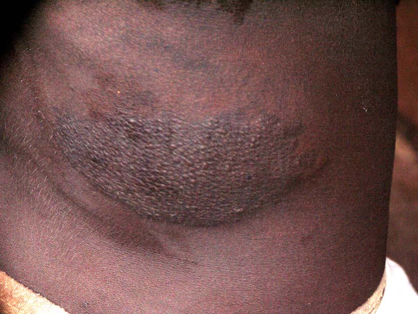 05 Fibromatosis on Mbaza's right rib cage